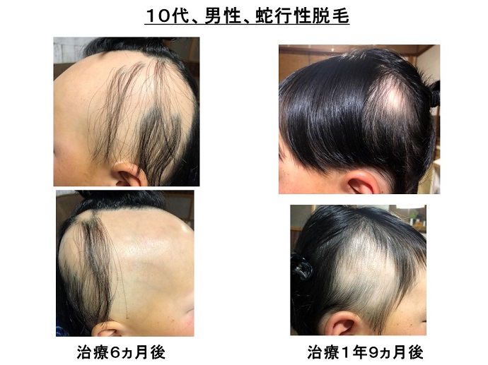 円形脱毛症　病院